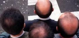 研究表明男性植发更有魅力 秃头更具领导力