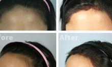 中国台湾dr.liu植发中心真实案例 种植发际线摆脱高额头