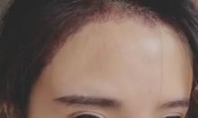 LOL女主播冯提莫微博自曝种植发际线照片 植发化解秃顶之灾