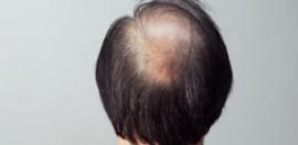 为什么说植发对脱发是比较有效的根治办法？