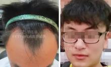 北京碧莲盛小陈的治脱经历 M型脱发植发11个月做回黑发少年