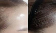 哈尔滨美佳娜植发告诉你 纹发际线和植发际线的四大不同