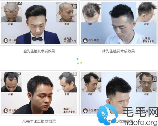 杭州新生植发真人案例图