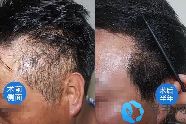 烫伤还是打伤导致,都要及时接受植发手术的治疗,而且疤痕植发可以有效