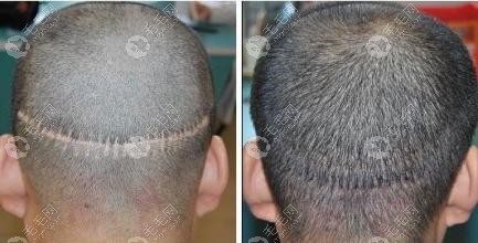fut植发后脑勺留下的疤痕怎么去除可以用fue植发技术修复吗