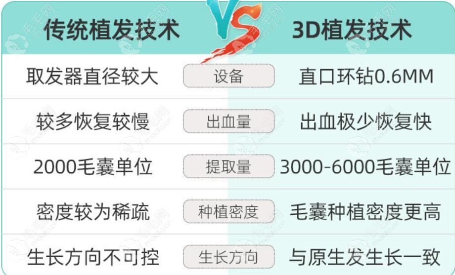 宁波新生3d植发技术的优势