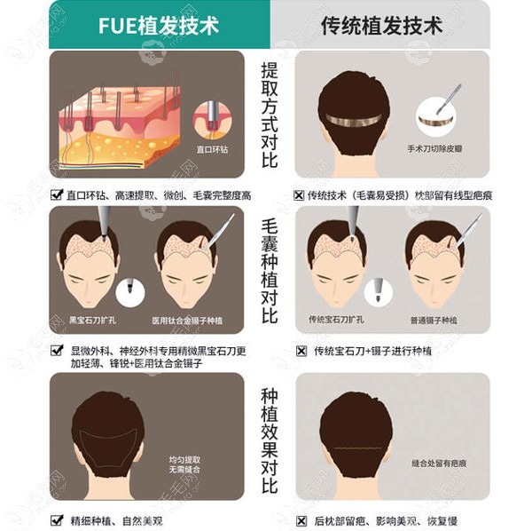 fue植发技术与传统植发技术