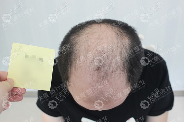 7级脱发植发后效果图图片