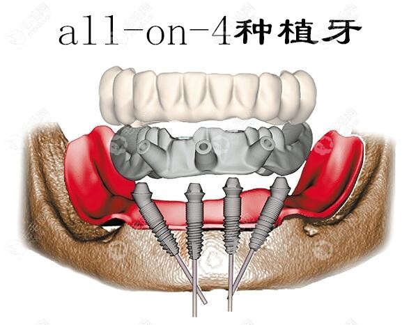 all-on-4/6全口即刻负重种植牙技术
