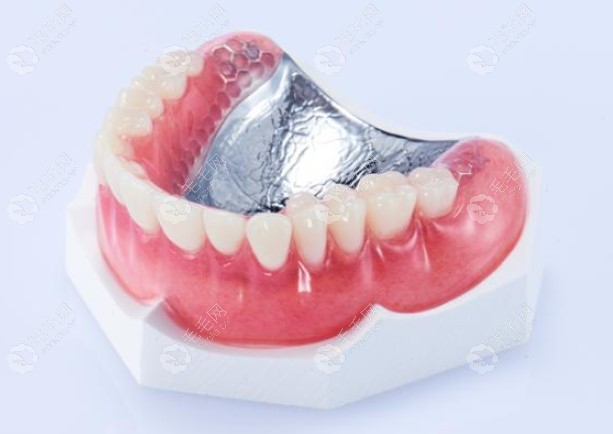 单个活动假牙的好处图片