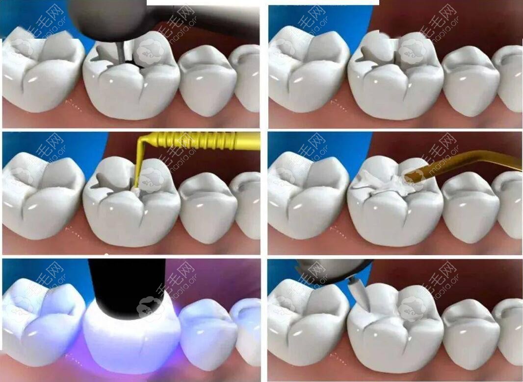 侧切牙补牙过程图片
