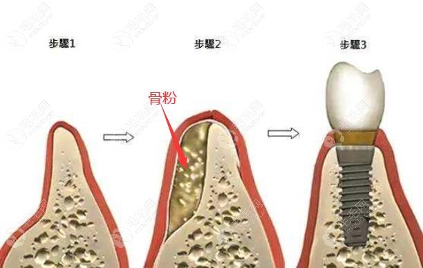 牙槽骨正常的图片图片