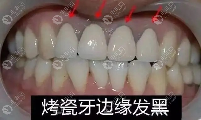 镶牙磨掉好牙容易出现牙龈黑线