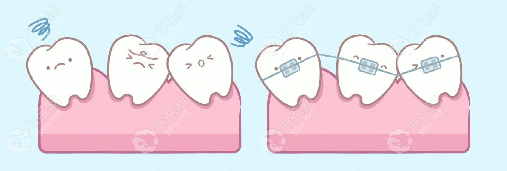广州小孩矫正牙齿龅牙手术多少钱