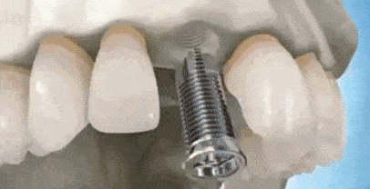 长沙优伢仕口腔医院种植牙